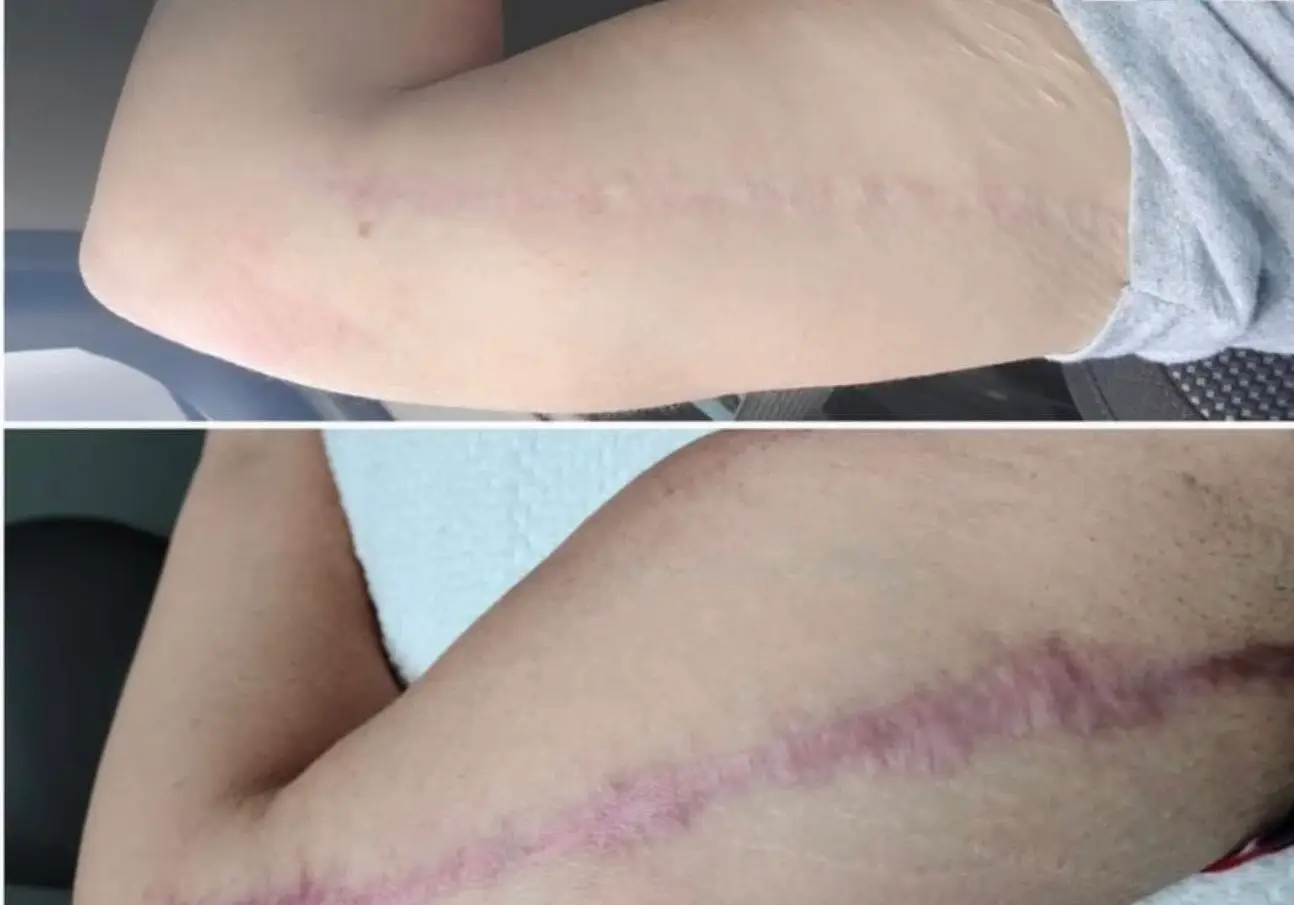 Scar reduction