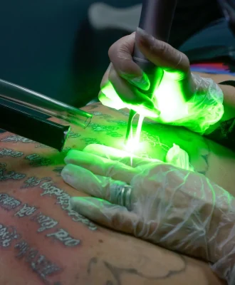 Tri Pulse tattoo removal